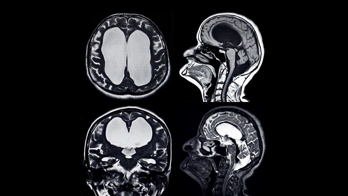 Снимки мрт гидроцефалия головного мозга